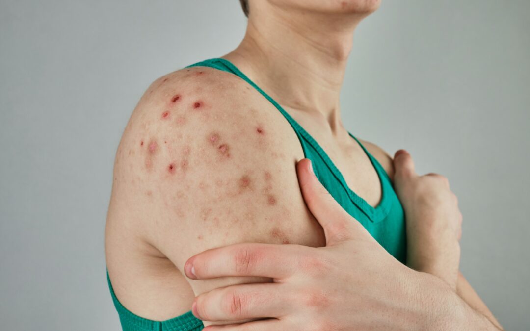 Solutions for Skin Infections in Mandeville: Trust In & Out Urgent Care for Expert Skin Health