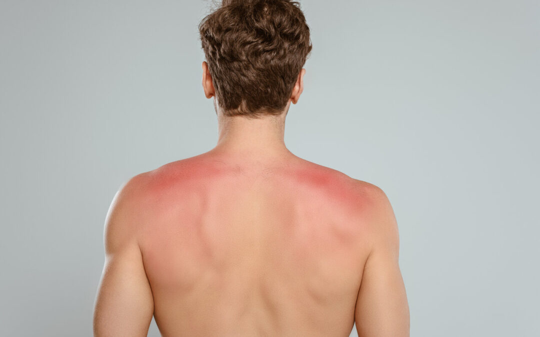 man with sunburn